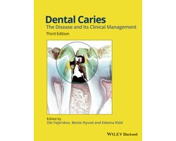 Dental Caries 3rd Edition — cadeau in Cadeau-ideeën